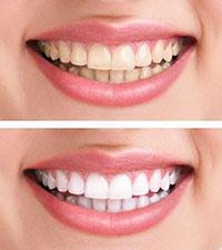 teeth-whitening-article